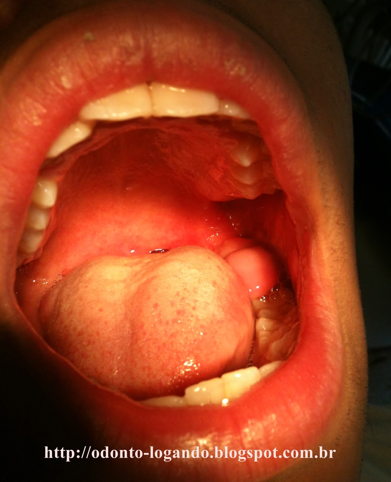 Odontologando: Preciso tirar o dente do siso?