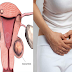 These Are The 7 Symptoms of Myomas/Fibroids and Home Remedies to Remove Them Naturally