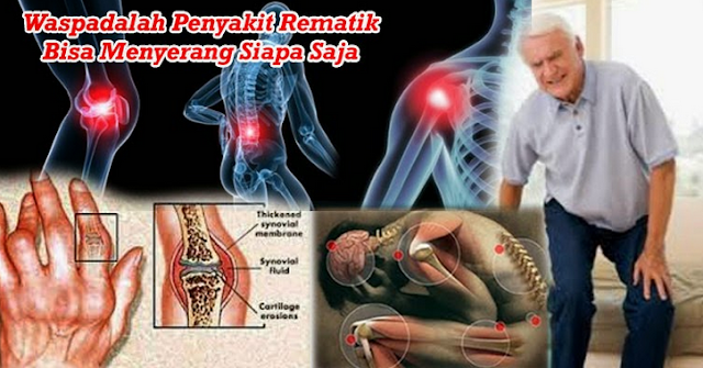 Obat Rematik Di Apotik