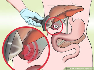 Tips pengobatan batu empedu Tips pengobatan batu empedu
