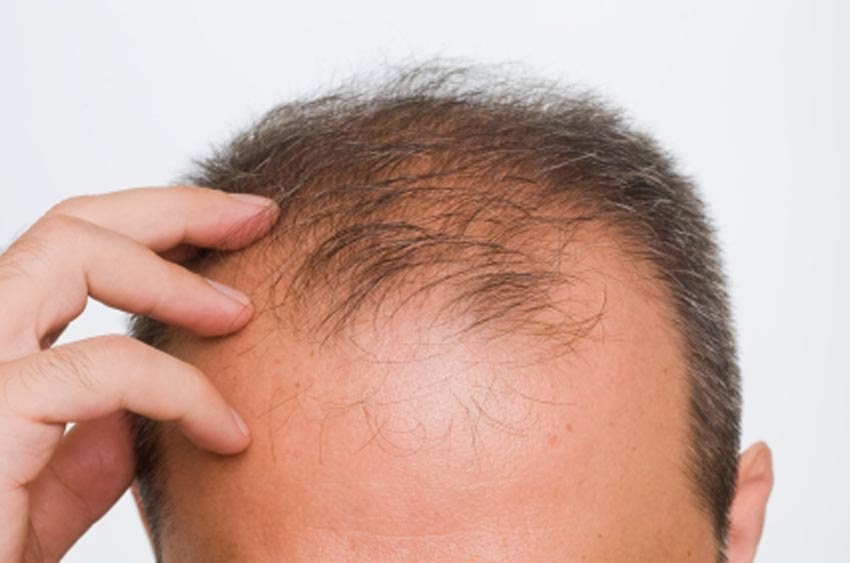 How to Cure Hair Loss Ask Me Questions, here is the answer