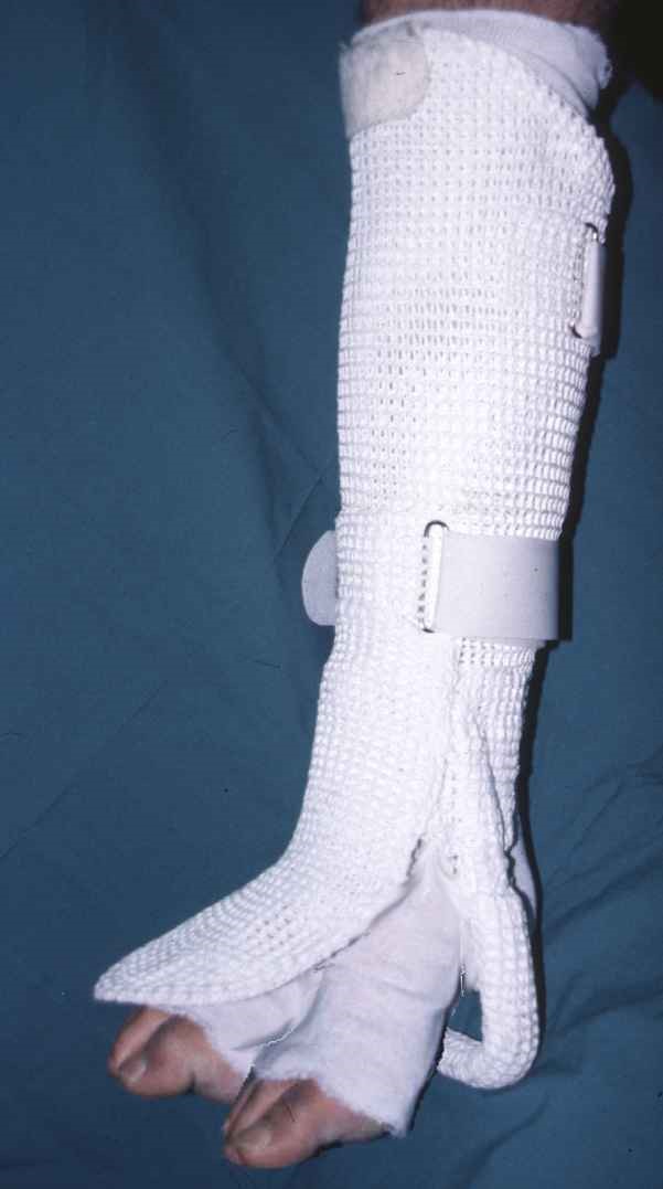 Orthopaedi dan Traumatologi: CIDERA TENDON ACHILLES PADA