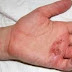 Apa Obat Gatal Pada Telapak Kaki Dan Tangan
