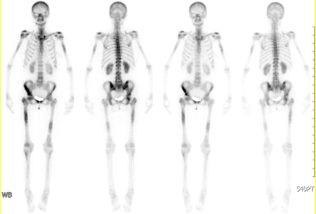 аппарат остеосцинтиграфия костей. сцинтиграфия полипозиционная костей что это. сканирование скелета при онкологии подготовка костей. остеосцинтиграфия бедренной кости. сцинтиграфия костей метастазы.