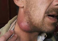 Penyebab, Akibat dan Pengobatan Benjolan Di Leher Penyebab, Akibat dan Pengobatan Benjolan Di Leher