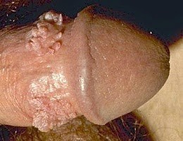 Obat Kutil Kelamin Alami cuka Obat Kutil Kelamin Alami cuka