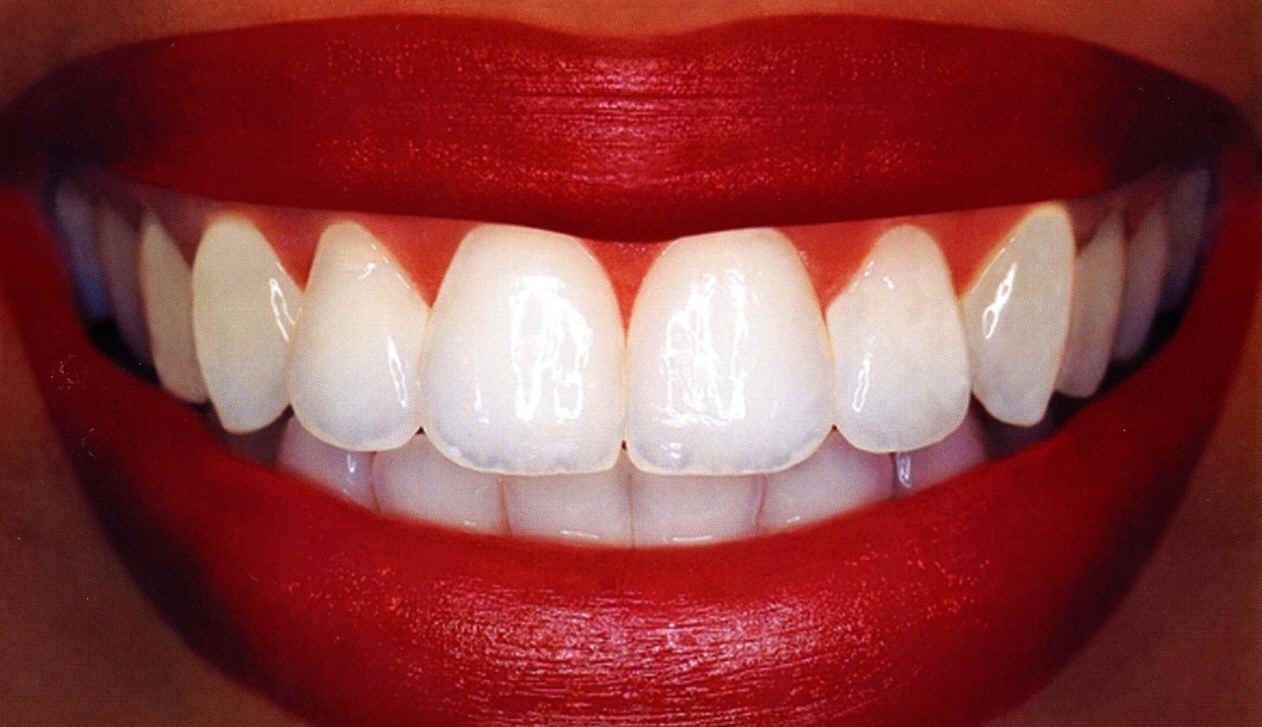 Wetherby Orthodontics, Our Blog: Cheap Teeth Whitening