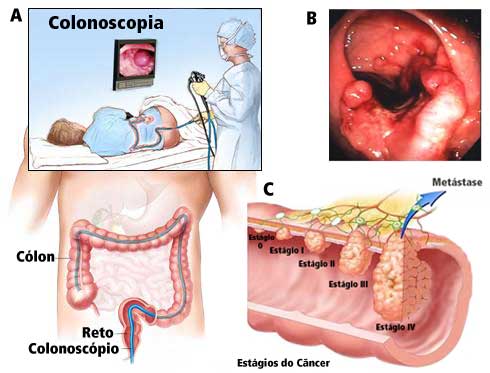 cancer colon que manger