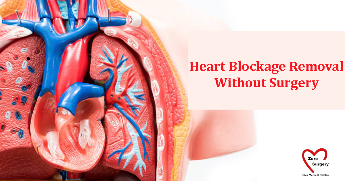 ACT Takes Less Time To Recover When Compared To Heart Bypass Surgery