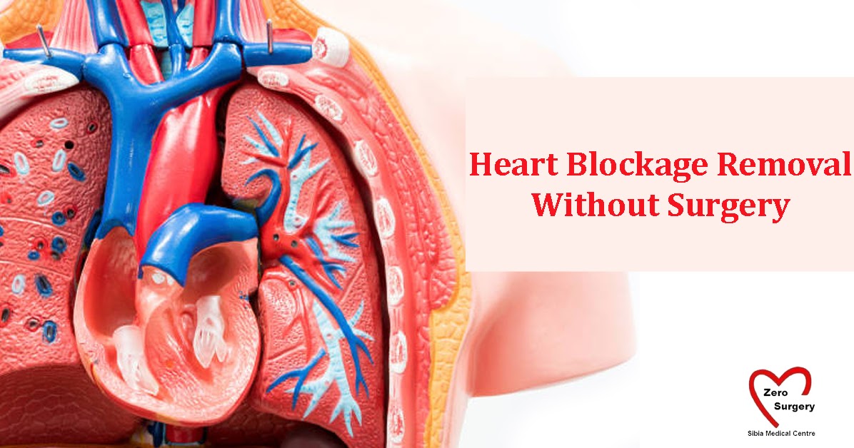 ACT Takes Less Time To Recover When Compared To Heart Bypass Surgery