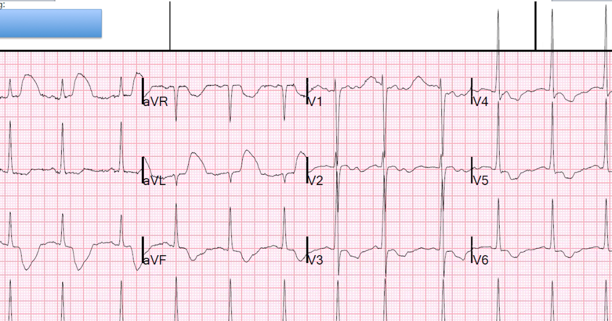 dr smith 39 s ecg blog hyperacute t waves hcmc my chart
