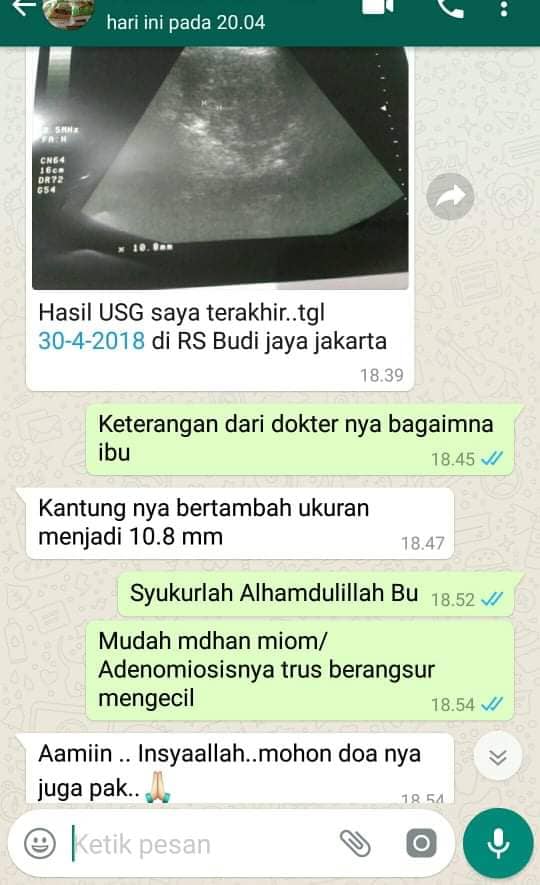 Adenomyosis Bisa Hamil Adenomyosis Bisa Hamil