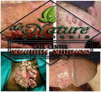 Foto Cara Mengatasi Kutil Kelamin Pada Pria