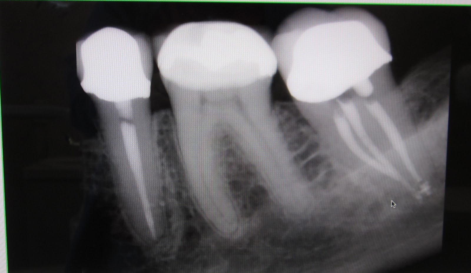 Root canal xray - hacjp