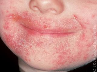 Candida facial causa