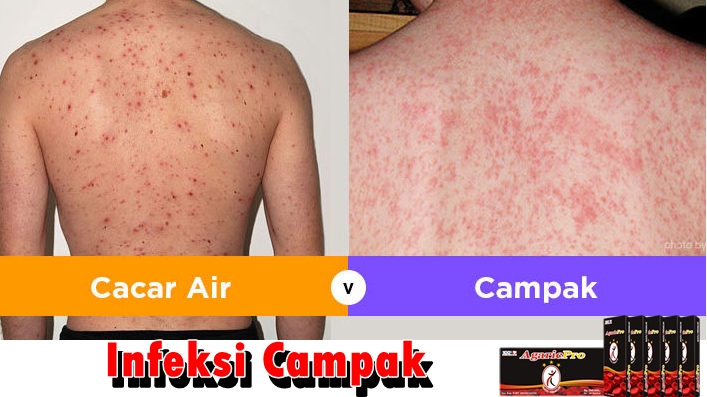 Obat Tradisional Campak Pada Bayi - Informasi Kesehatan 2020