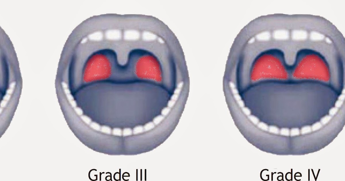 How Often is Tonsillectomy Performed After Prior Adenoidectomy for