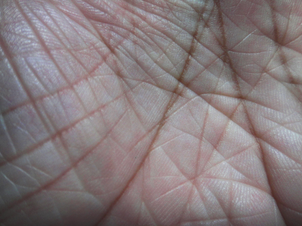 ichthyosis vulgaris hands