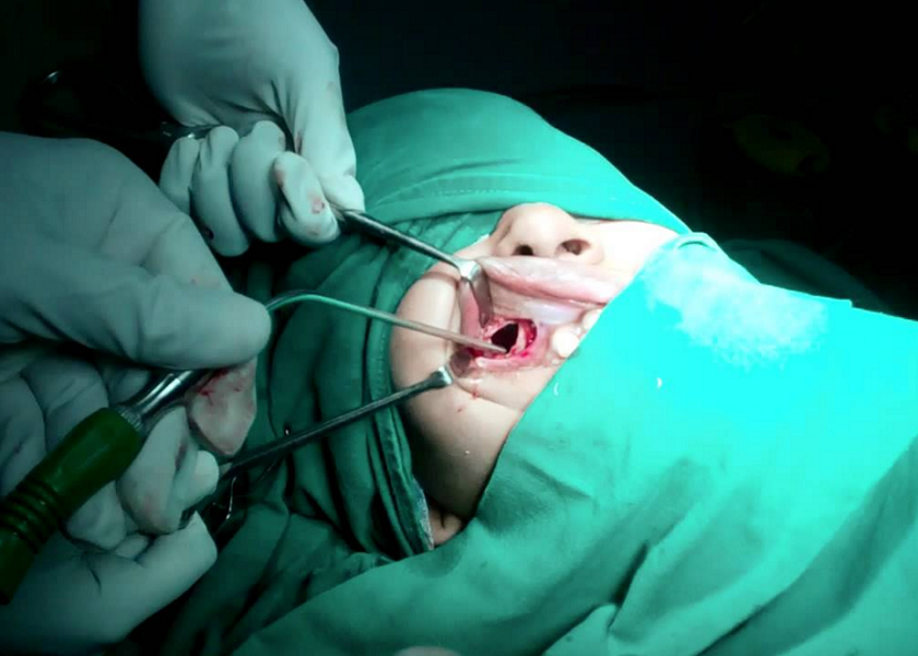 Pengobatan Sinusitis