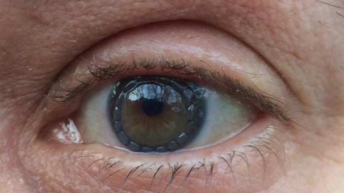 Photo of Corneal Transplant and the Stitches, by Melissa Lamont Gordon