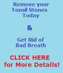 Cure Tonsil Stones