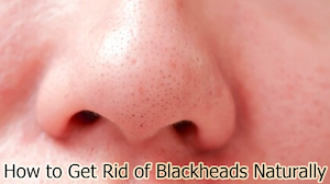 How to Get Rid of Blackheads Naturally How to Get Rid of Blackheads Naturally