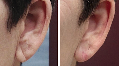 , SKINMD SOLUTIONS FOR EAR REJUVENATION- NO MORE SAGGY EARLOBES