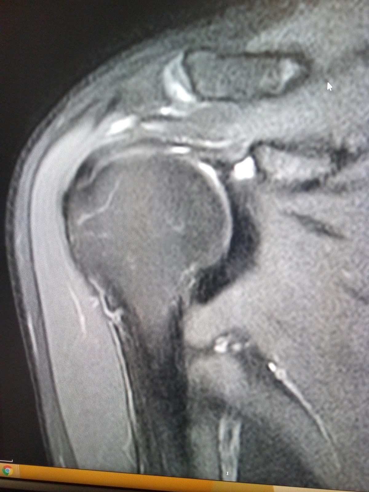 Adhesive capsulitisMRI Sumer's Radiology Blog