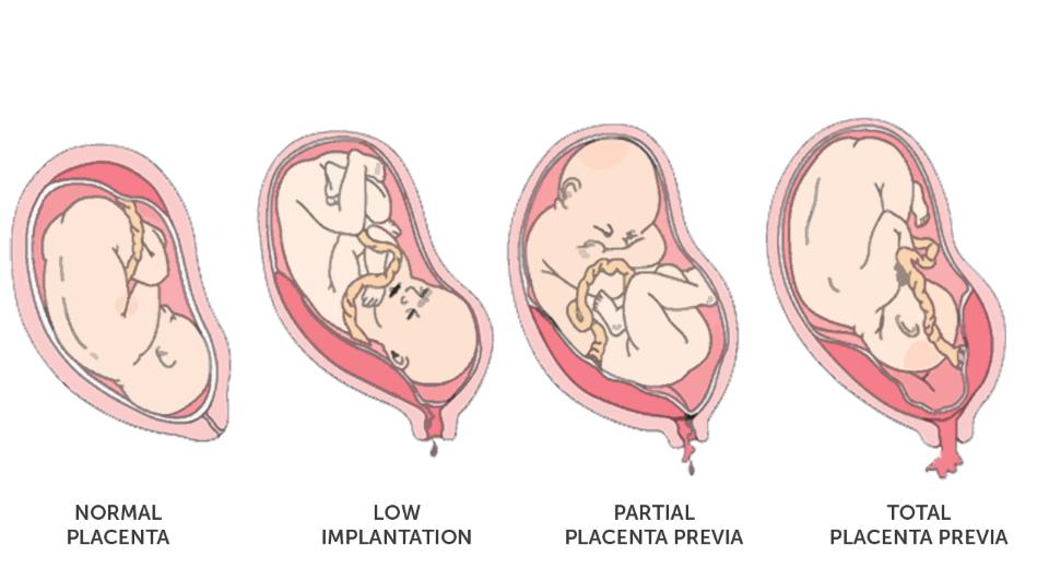 what is placenta previa in pregnancy socapregna
