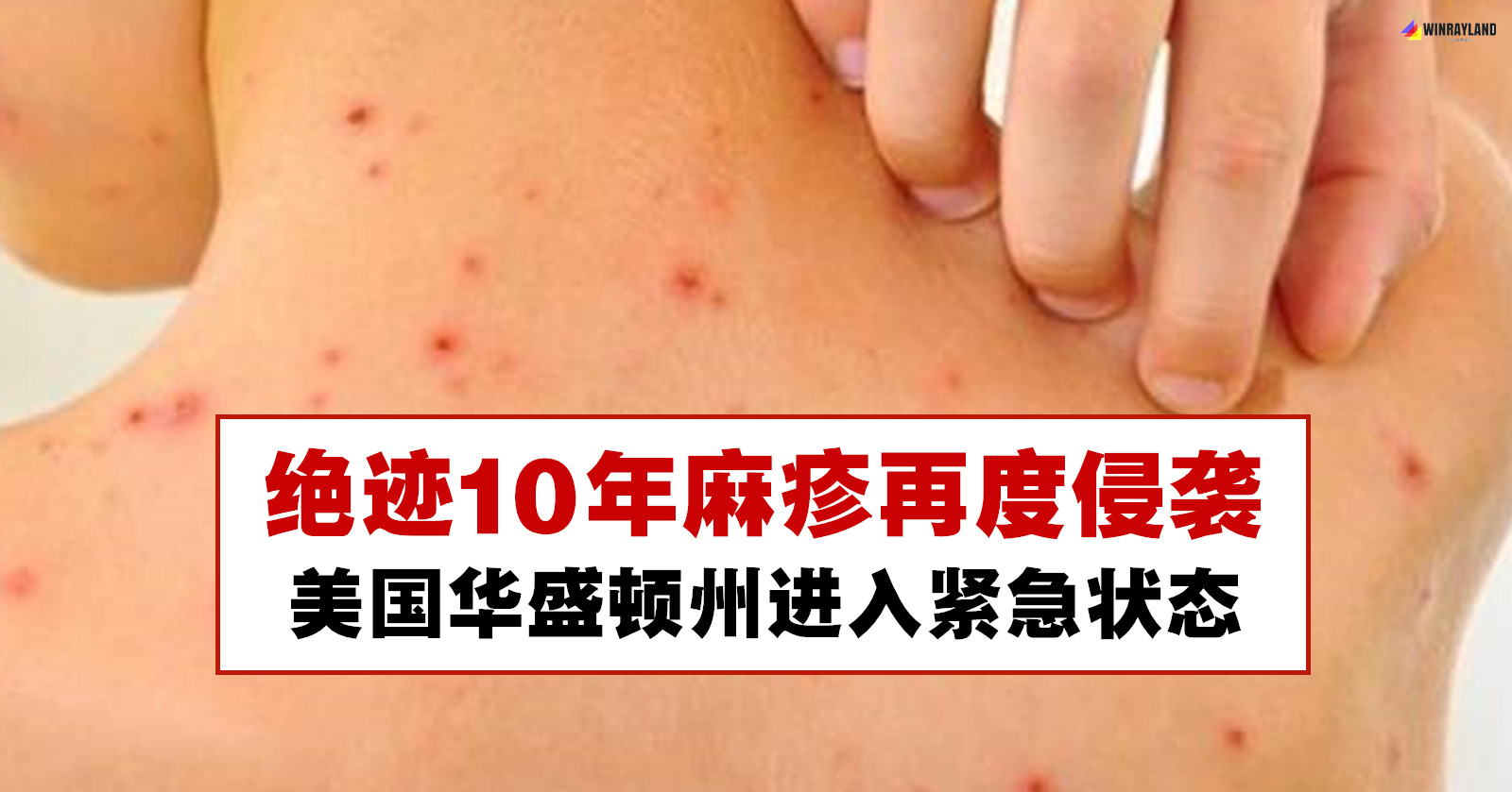 Image result for 美国éo»ç–1ä¼ æŸ“