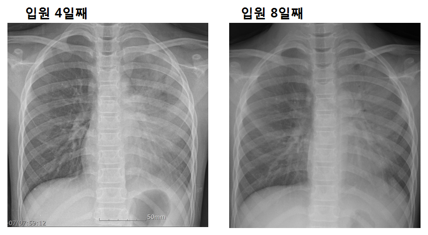 세균성 장염으로 입원한 라이노바이러스 아기 10