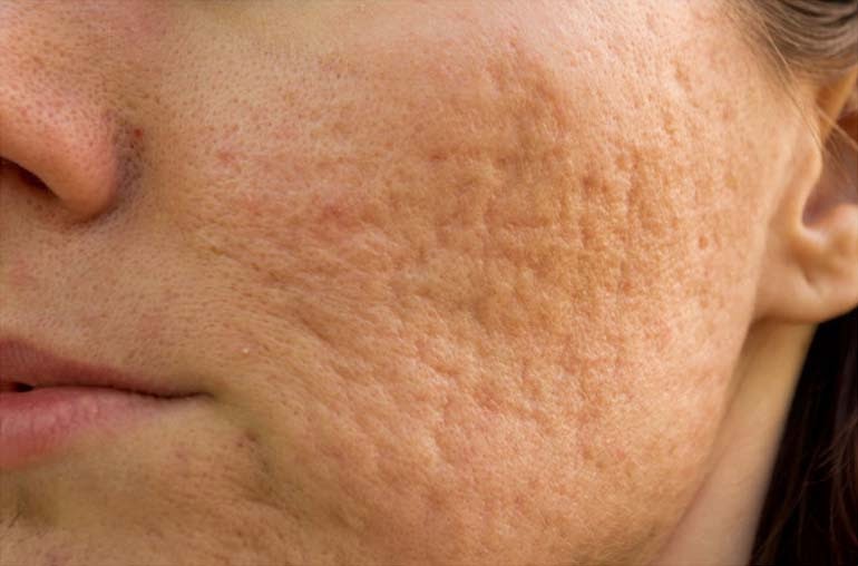 Pimples Face Seven Causes Of Adult Back Acne