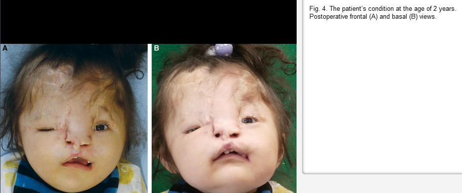 Facial Clefts And 26