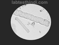 Urine Microscopic - hyaline casts