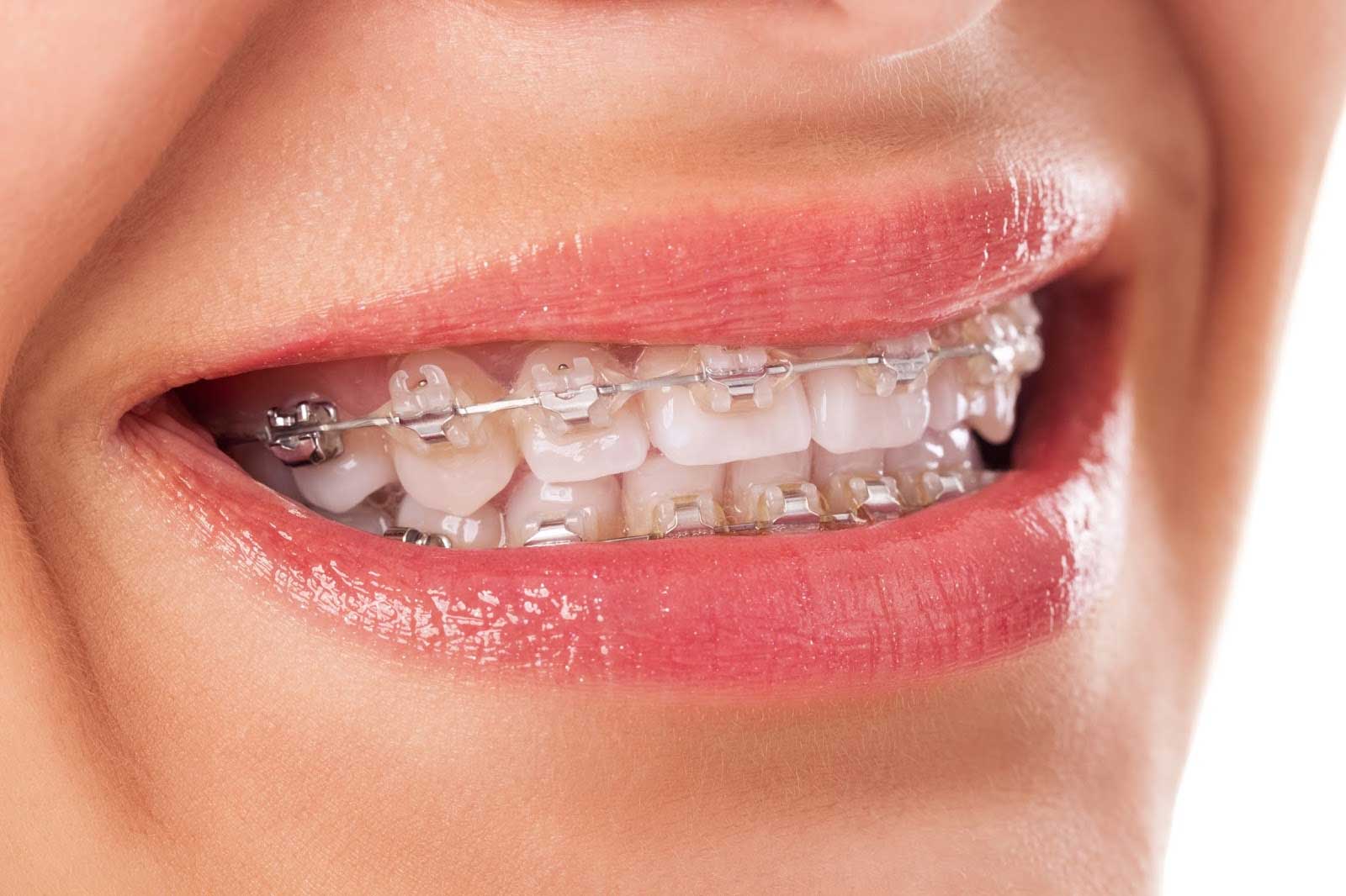 Penjelasan Tentang Behel Metal, Tehknologi Kawat Gigi yang Tidak Sakit