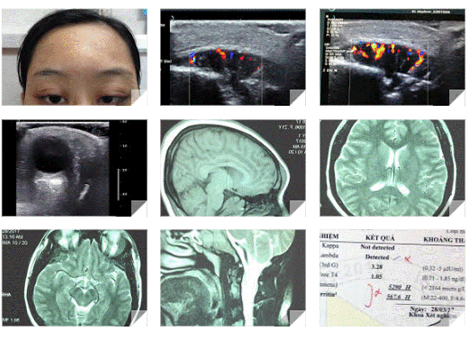 VIETNAMESE MEDIC ULTRASOUND CASE 425 FRONTAL BONE TUMOR, Dr PHAN