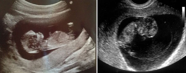 10 Haftalık Bebek Ultrason Görüntüsü 10 Haftalık Bebek Ultrason Görüntüsü