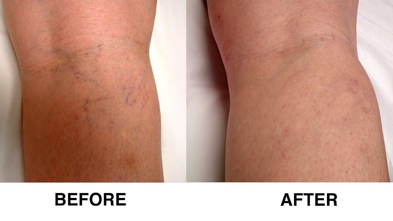 Symptoms Of A Dvt Behind The Knee Knee Choices