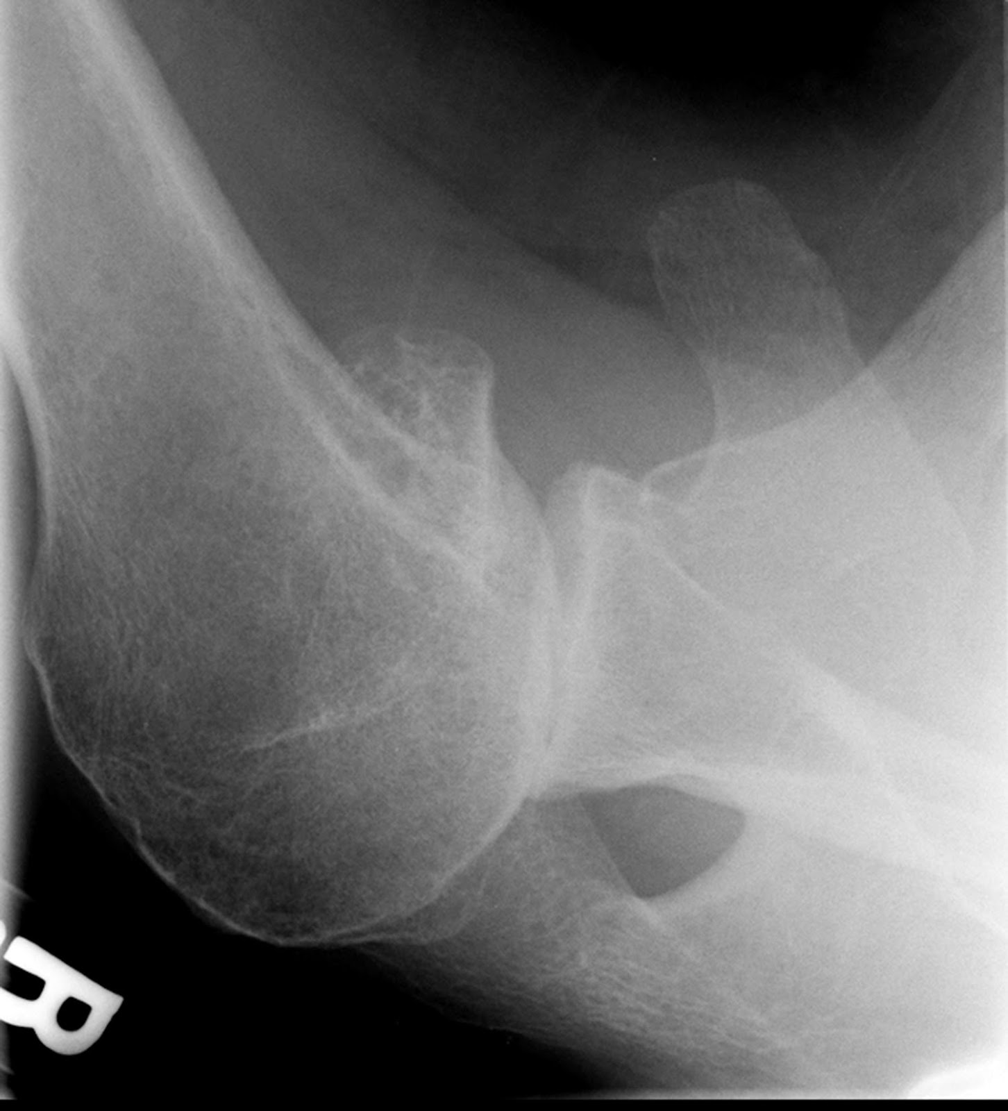 UW Shoulder and Elbow Academy: Is a CT scan needed before a shoulder ...