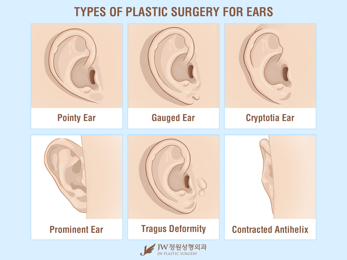 Understand and buy ear correction surgery OFF-55