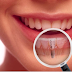 Những điều không phải ai cũng biết về cấy ghép răng implant