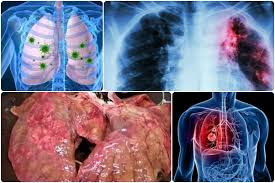 Obat infeksi paru paru ampuh