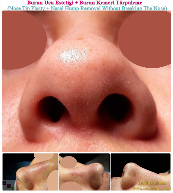 Nose tip plasty operation in İstanbul - Nose tip lifting in İstanbul - Tip plasty in İstanbul - Nose tip reshaping in İstanbul - Nose tip surgery in Turkey - Open technique tip plasty operation in İstanbul