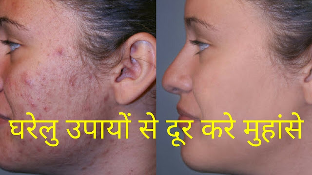 गर्मियों के मौसम में इन घरेलु उपायों से दूर करे मुहांसे गर्मियों के मौसम में इन घरेलु उपायों से दूर करे मुहांसे