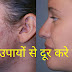 गर्मियों के मौसम में इन घरेलु उपायों से दूर करे मुहांसे
