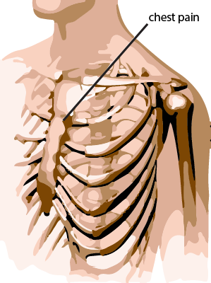 Precordial catch syndrome - Texidor’s Twinge