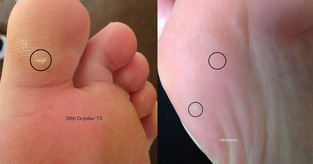 Top 20 of Start Of A Planters Wart cmaomaomemories