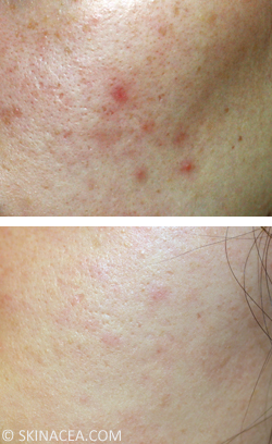 Picture of How to fade red acne marks ?: Best Tips on How to Fade Acne Scars