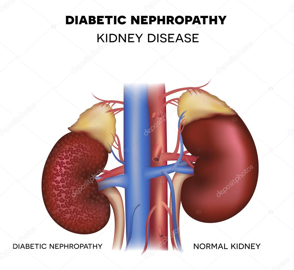diabetische nephropathie icd 10)