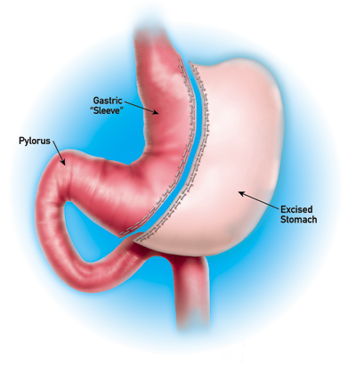 Best option sleeve or bypass